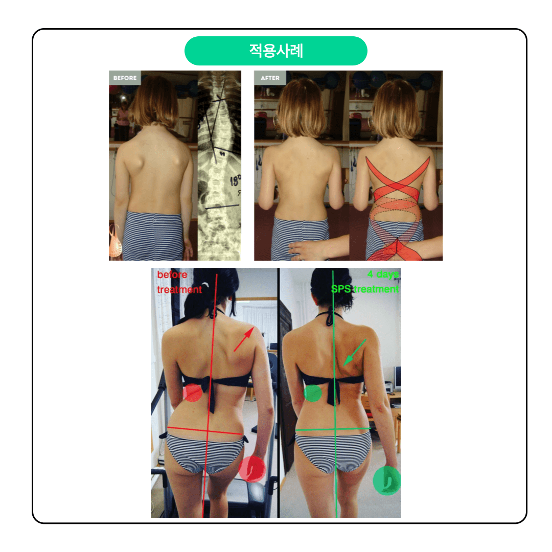 SPS 척추나선근육안정화운동 척추측만증(Scoliosis) 파트 6