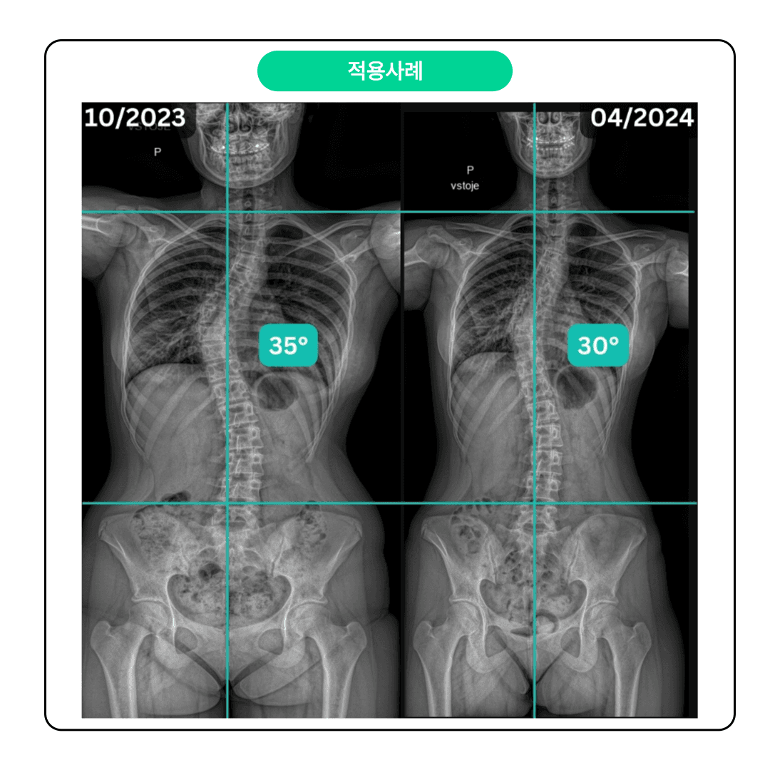 SPS 척추나선근육안정화운동 척추측만증(Scoliosis) 파트 4